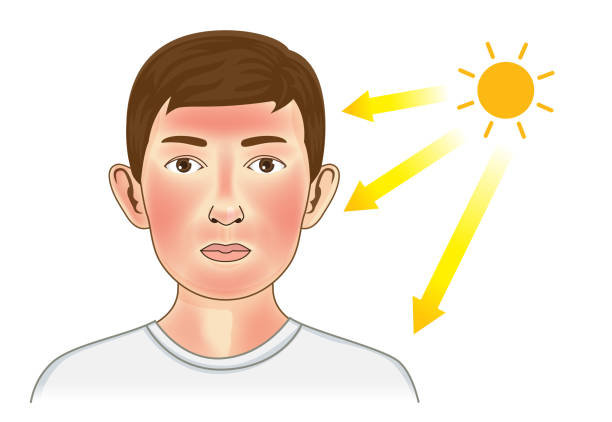 كيفية علاج حروق الشمس